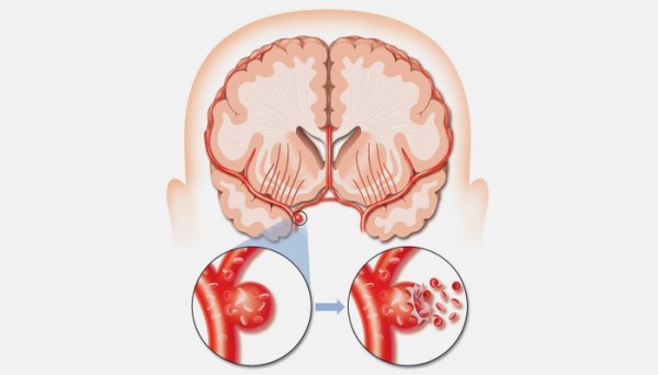 Аневризма сосудов головного мозга