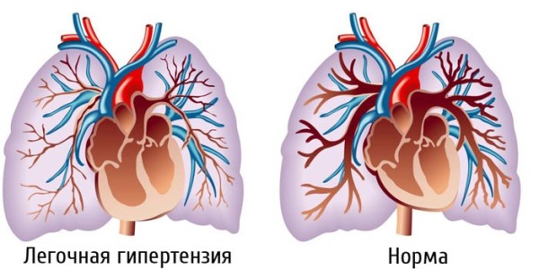 Силденафил для женщин