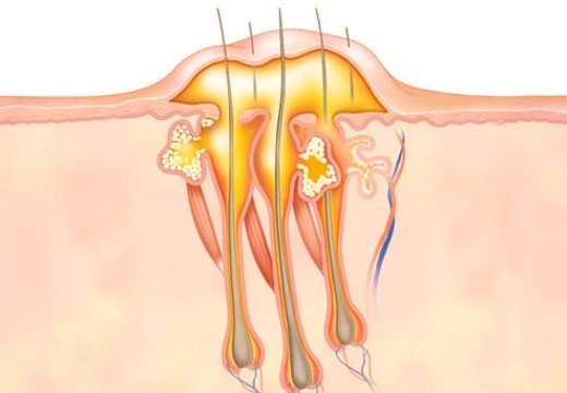 Опасность образования гнойных фурункулов и причины появления
