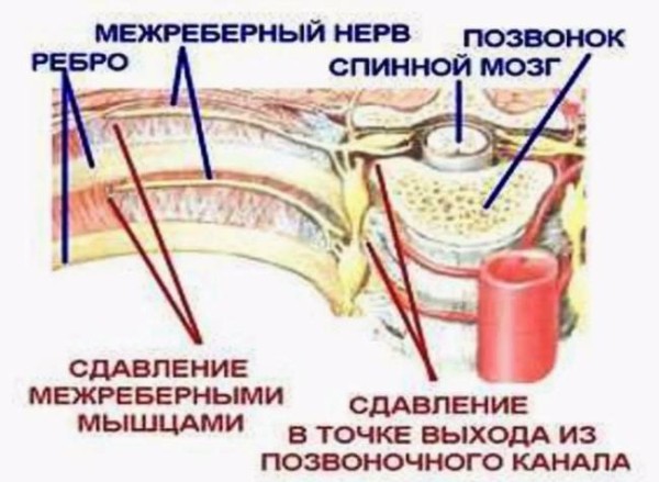 Что такое межреберная невралгия