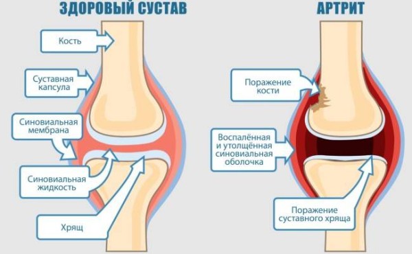 6 причин стреляющей боли в ногах